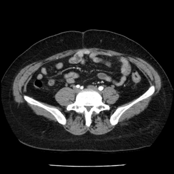 File:Adrenal myelolipoma (Radiopaedia 43401-46759 Axial C+ arterial phase 71).jpg