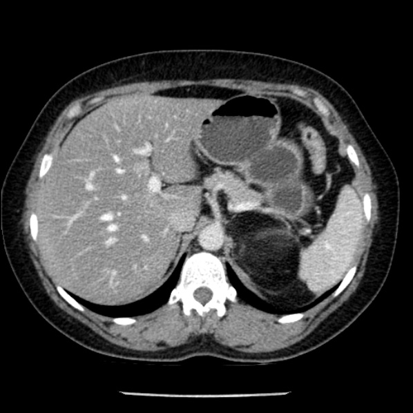 Adrenal myelolipoma (Radiopaedia 43401-46759 Axial C+ portal venous phase 20).jpg