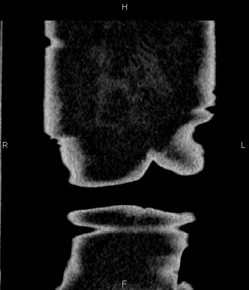 Adrenal myelolipoma (Radiopaedia 82742-96986 Coronal renal cortical phase 79).jpg