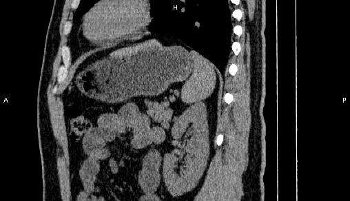 Adrenal myelolipoma (Radiopaedia 84321-99619 Sagittal non-contrast 78).jpg
