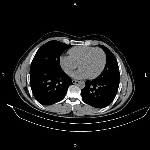 Adrenal myelolipoma (Radiopaedia 87794-104246 Axial non-contrast 3).jpg