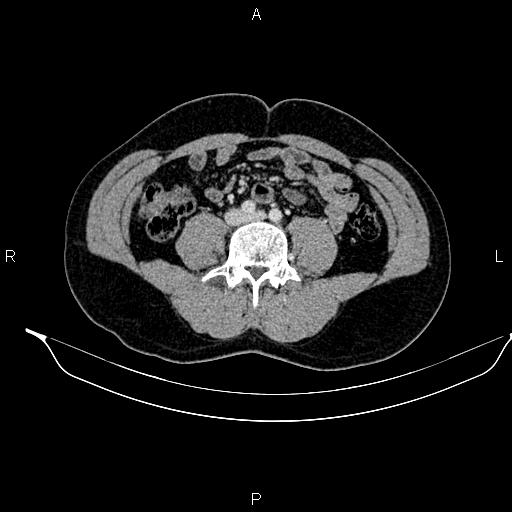 File:Adrenal myelolipoma (Radiopaedia 87794-104246 Axial renal cortical phase 65).jpg