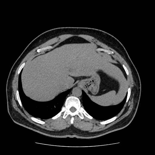 Adrenal myelolipoma and beaver tail liver (Radiopaedia 86201-102193 Axial non-contrast 72).jpg