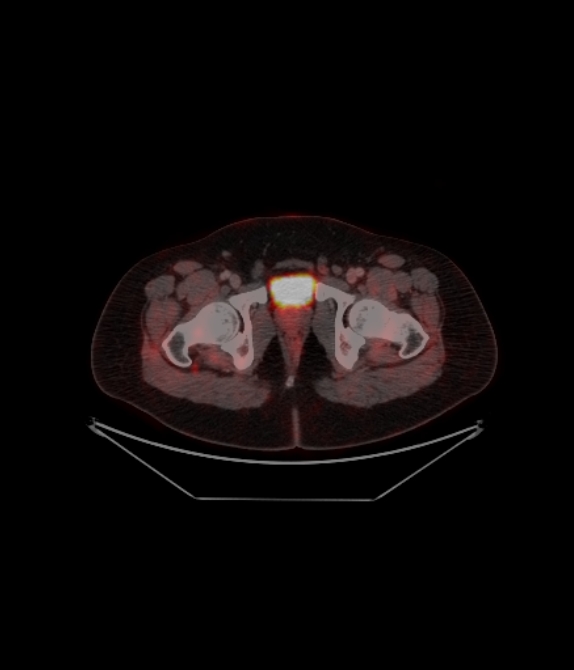 Adrenocortical carcinoma (Radiopaedia 80134-93440 ِAxial 253).jpg