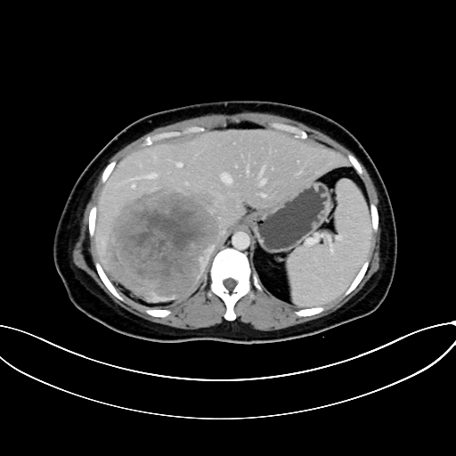 Adrenocortical carcinoma (Radiopaedia 87281-103569 Axial C+ portal venous phase 21).jpg