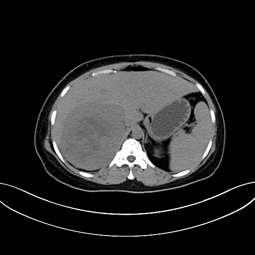 Adrenocortical carcinoma (Radiopaedia 87281-103569 Axial non-contrast 23).jpg