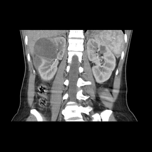 File:Adult polycystic kidney disease (Radiopaedia 48845-53876 Coronal renal cortical phase 26).jpg