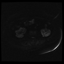 Adult polycystic kidney disease (Radiopaedia 59075-66365 Axial DWI 40).jpg