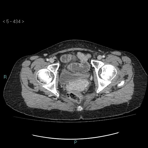 Adult transient intestinal intussusception (Radiopaedia 34853-36310 Axial C+ portal venous phase 115).jpg