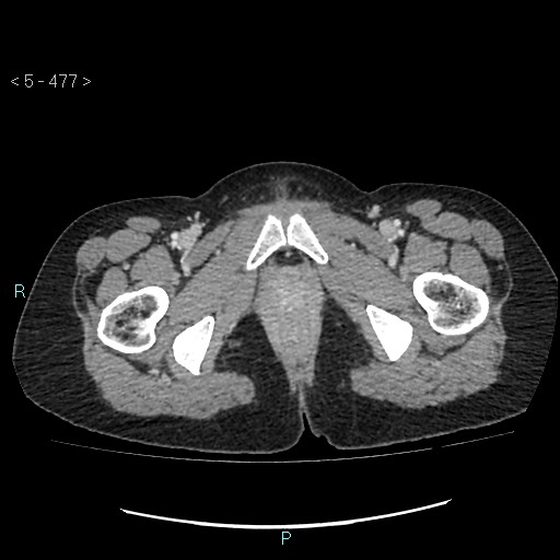 Adult transient intestinal intussusception (Radiopaedia 34853-36310 Axial C+ portal venous phase 130).jpg