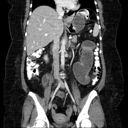 File:Afferent loop syndrome - secondary to incarcerated trocar site hernia (Radiopaedia 82959-97305 Coronal C+ portal venous phase 86).jpg