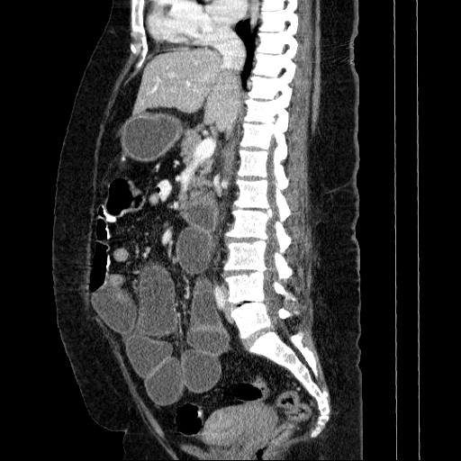 Afferent loop syndrome - secondary to incarcerated trocar site hernia (Radiopaedia 82959-97305 Sagittal C+ portal venous phase 81).jpg