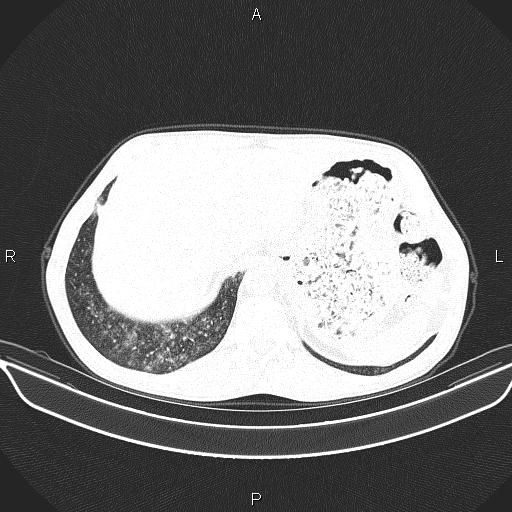 Air bronchogram in pneumonia (Radiopaedia 85719-101512 Axial lung window 63).jpg