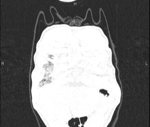 Air bronchogram in pneumonia (Radiopaedia 85719-101512 Coronal lung window 3).jpg