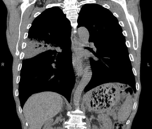 Air bronchogram in pneumonia (Radiopaedia 85719-101512 Coronal non-contrast 36).jpg