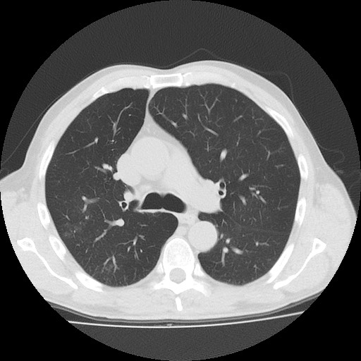 Allergic bronchopulmonary aspergillosis (ABPA) (Radiopaedia 60594-68313 Axial lung window 24).jpg