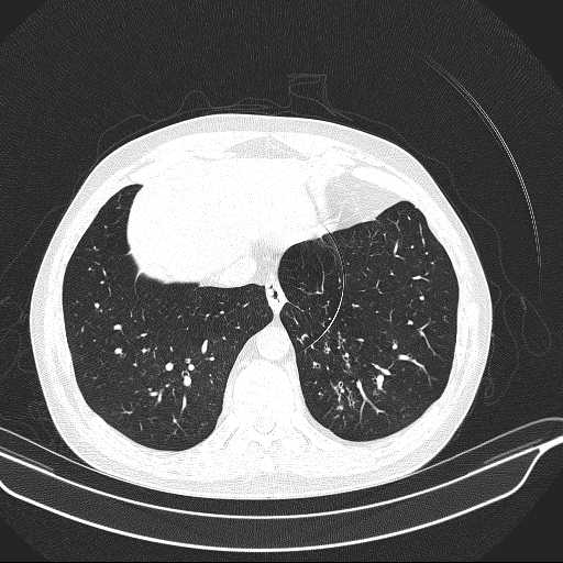 File:Allergic bronchopulmonary aspergillosis (Radiopaedia 21386-21320 Axial lung window 31).jpg