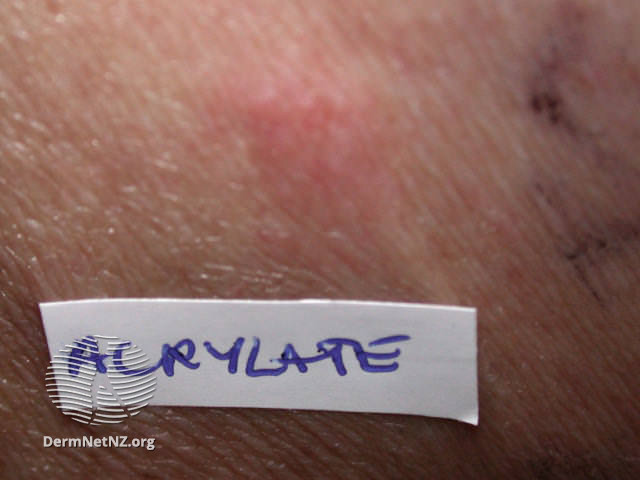 File:Allergic patch test due to acrylate (DermNet NZ dermatitis-acrylate-patch).jpg