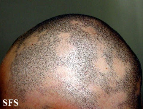 Alopecia Areata (Dermatology Atlas 22).jpg