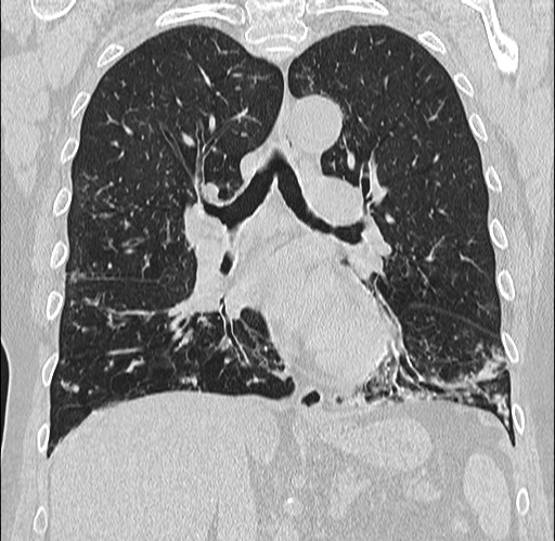 Alpha-1-antitrypsin deficiency (Radiopaedia 72058-82557 Coronal lung window 45).jpg