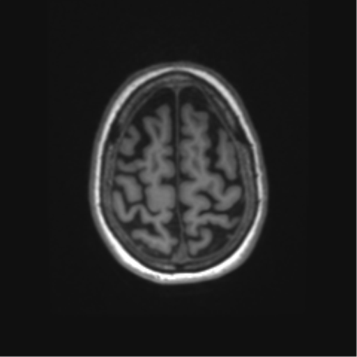Alzheimer's disease (Radiopaedia 42658-45802 Axial T1 31).png