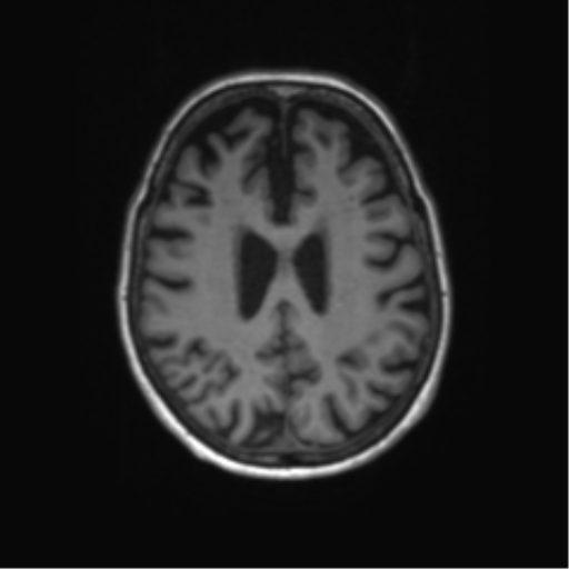 File:Alzheimer's disease (Radiopaedia 42658-45802 Axial T1 56).png