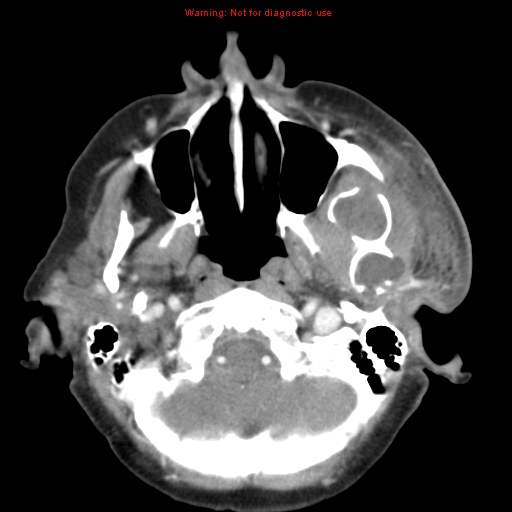 Ameloblastoma (Radiopaedia 27437-27631 A 20).jpg