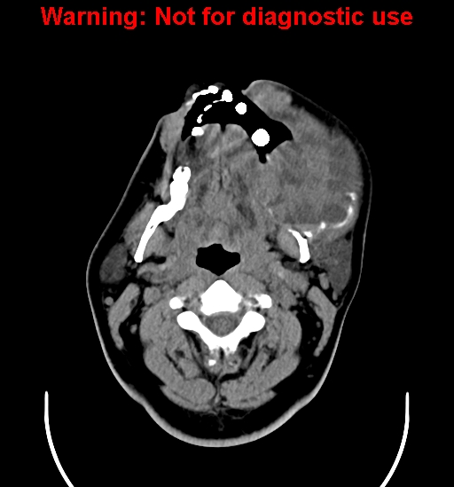 File:Ameloblastoma (Radiopaedia 33126-34164 A 8).jpg