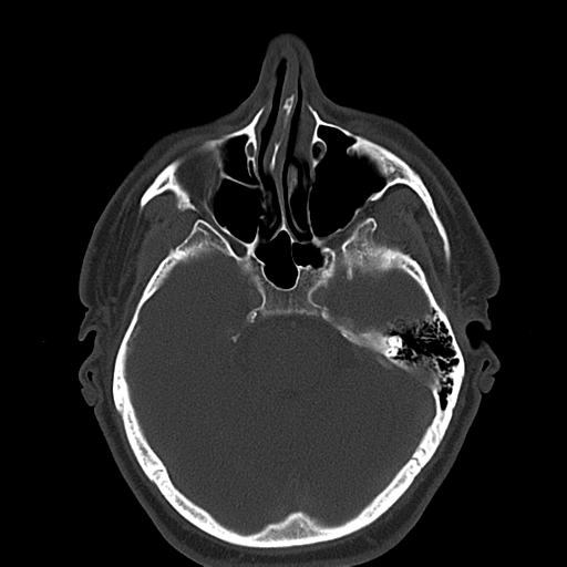 Ameloblastoma (Radiopaedia 38520-40623 Axial bone window 9).png