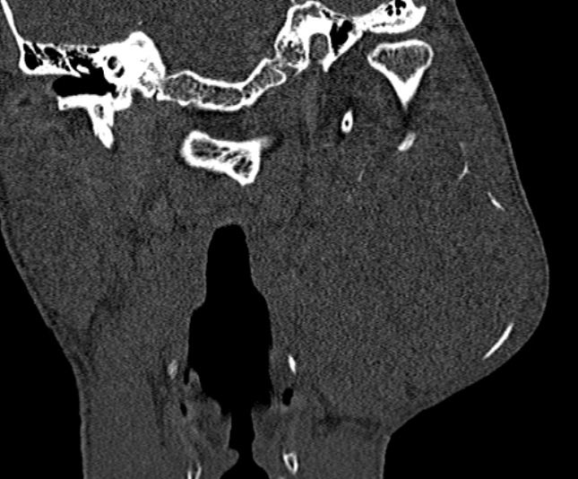Ameloblastoma (Radiopaedia 51921-57766 Coronal bone window 193).jpg