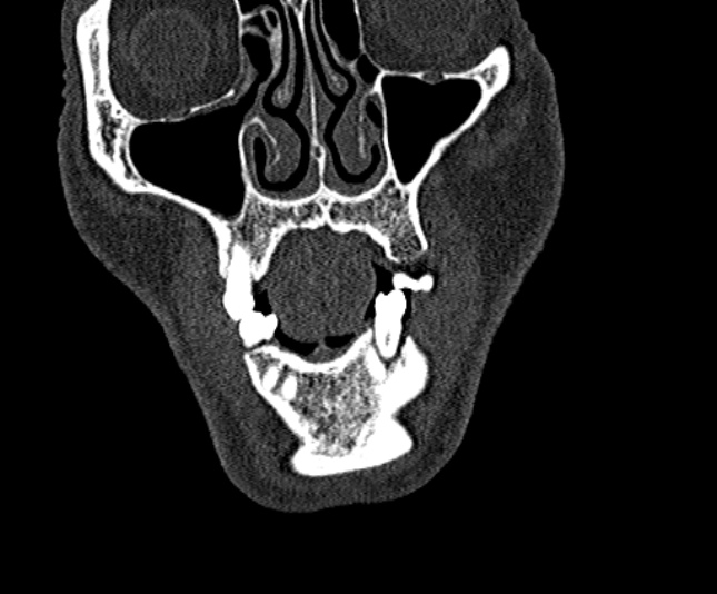 Ameloblastoma (Radiopaedia 51921-57766 Coronal bone window 41).jpg
