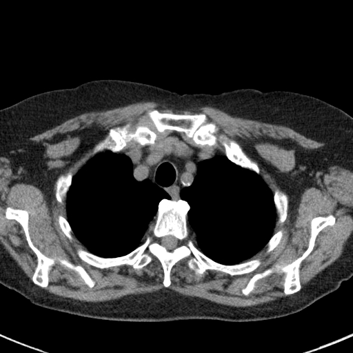 File:Amiodarone-induced pulmonary fibrosis (Radiopaedia 82355-96460 Axial non-contrast 14).jpg