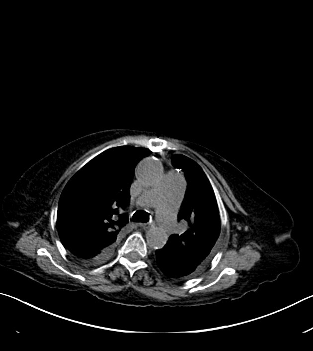 Amiodarone deposition in the liver (Radiopaedia 77587-89780 Axial non-contrast 30).jpg