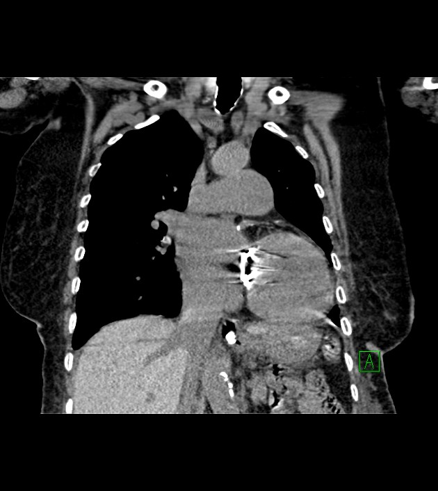 Amiodarone deposition in the liver (Radiopaedia 77587-89780 Coronal non-contrast 36).jpg