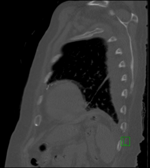 Amiodarone deposition in the liver (Radiopaedia 77587-89780 Sagittal bone window 24).jpg