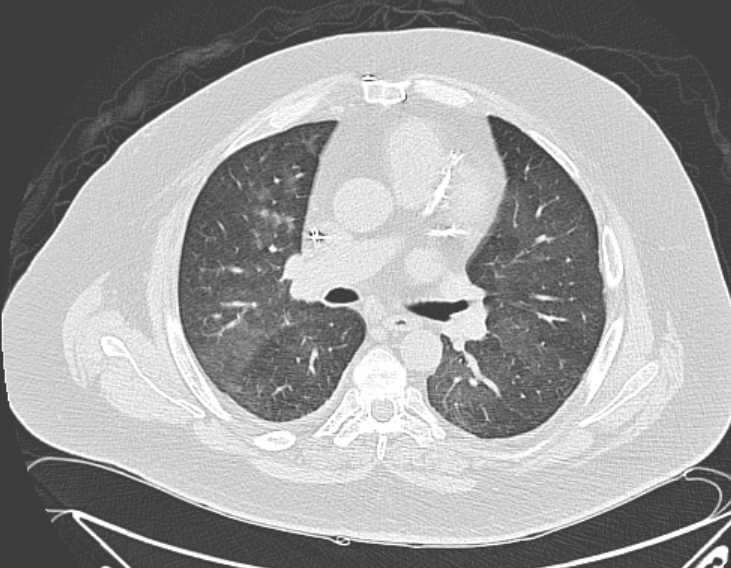Amiodarone lung (Radiopaedia 62514-70769 Axial lung window 41).jpg