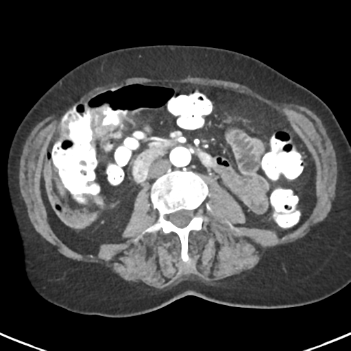 Ampullary adenocarcinoma (Radiopaedia 34013-35237 B 50).png