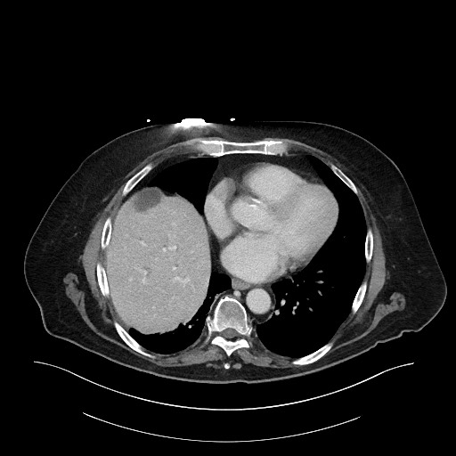 File:Ampullary adenocarcinoma (Radiopaedia 59373-66734 C 16).jpg
