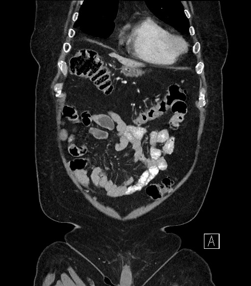 Ampullary adenocarcinoma (Radiopaedia 59373-66734 D 13).jpg