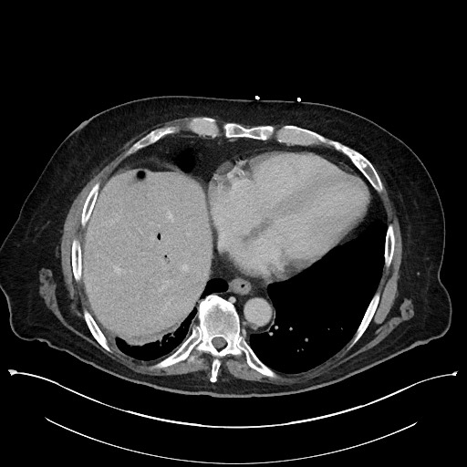Ampullary adenocarcinoma (Radiopaedia 59373-66737 A 23).jpg