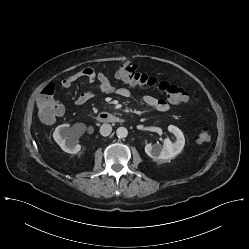 Ampullary adenocarcinoma (Radiopaedia 59373-66737 A 77).jpg
