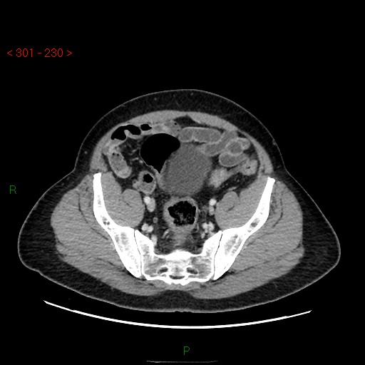 Ampullary carcinoma (Radiopaedia 56396-63056 C 81).jpg