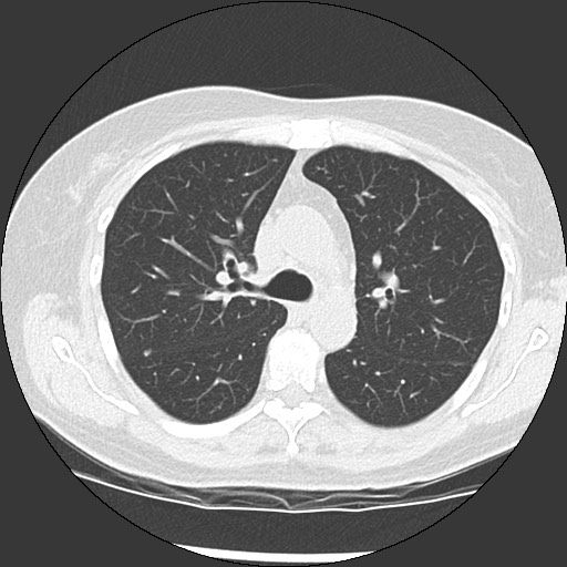 Amyloidosis - bronchial and diffuse nodular pulmonary involvement (Radiopaedia 60156-67744 B 21).jpg