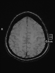 Amyotrophic lateral sclerosis (Radiopaedia 70821-81017 Axial SWI 44).jpg