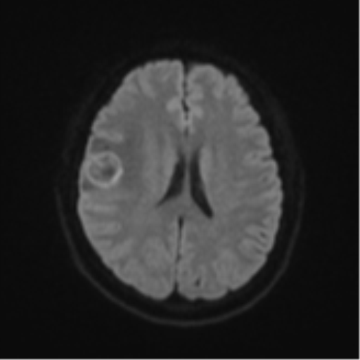 Anaplastic astroblastoma (Radiopaedia 55666-62194 Axial DWI 46).png