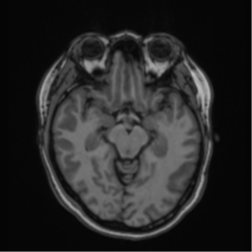 Anaplastic astroblastoma (Radiopaedia 55666-62194 Axial T1 31).png