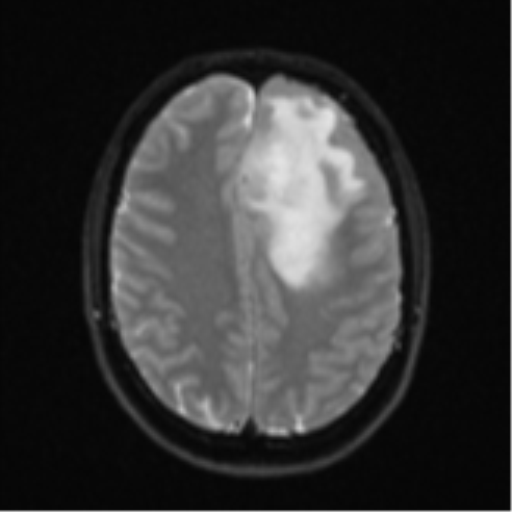 Anaplastic astrocytoma (Radiopaedia 57768-64731 Axial DWI 20).png