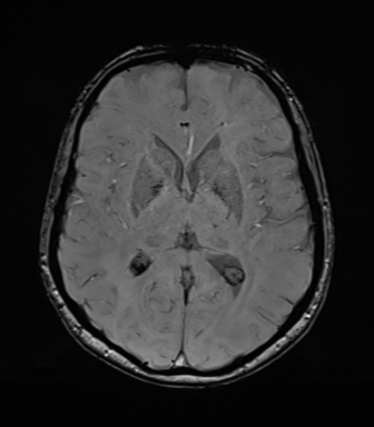 Anaplastic astrocytoma (Radiopaedia 86943-103160 Axial SWI 48).png