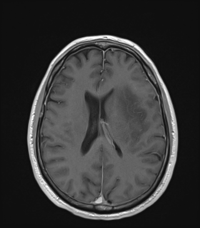 File:Anaplastic astrocytoma IDH wild-type (Radiopaedia 49984-55273 Axial T1 C+ 36).png