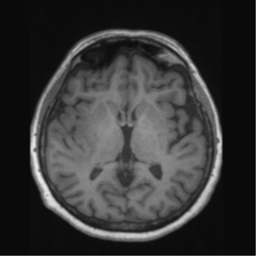 Anaplastic astrocytoma IDH wild-type (pseudoprogression) (Radiopaedia 42209-45276 Axial T1 80).png